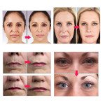 Derma Skin Therapy 540 Micro Needle Derma Roller